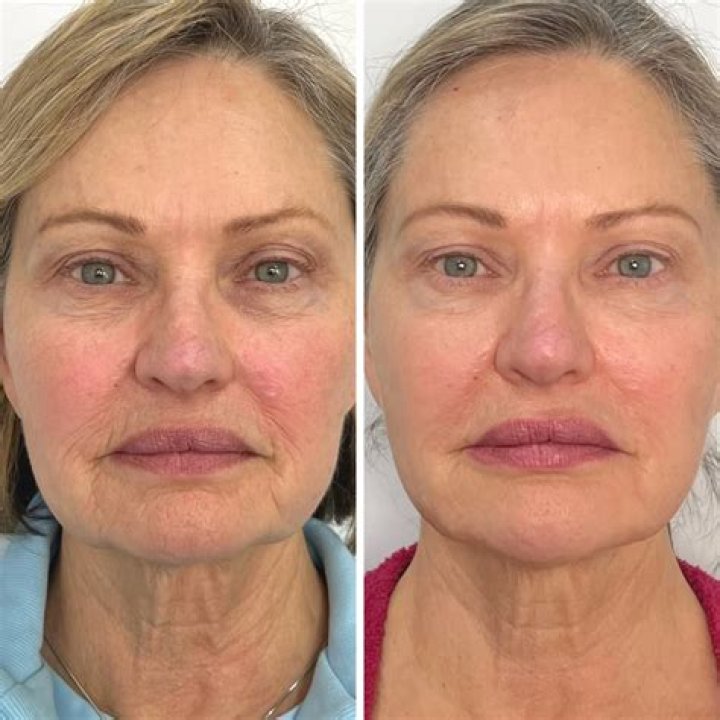 Has Martin Short Done Plastic Surgery? Before And After Photos